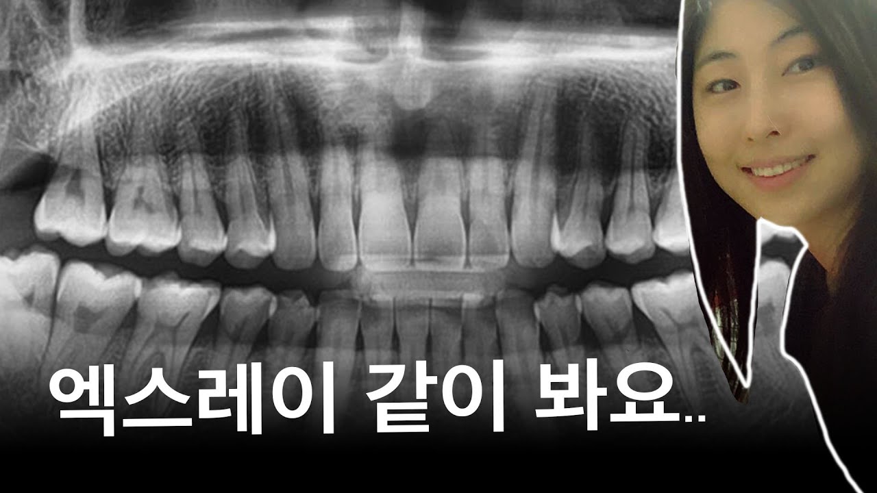 치과에서 보여주는 파노라마 엑스레이 보는 법!!