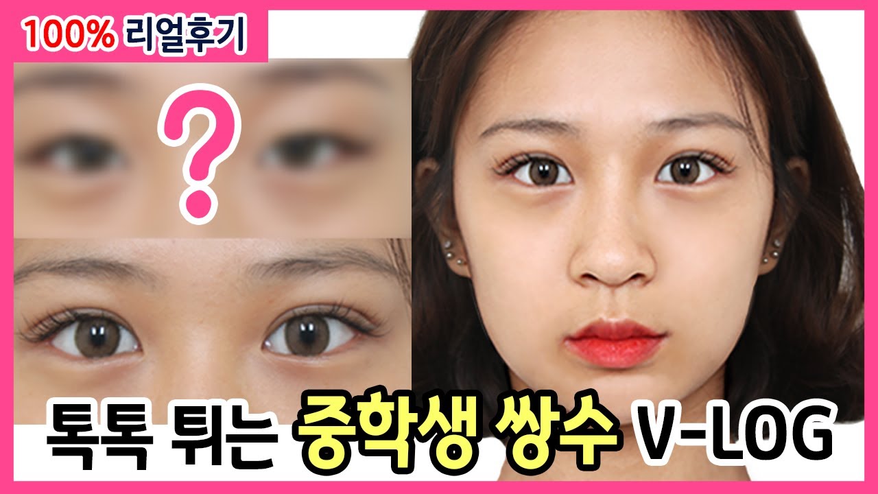 [V-log] 👀톡톡 튀는 중3학생의 100% 리얼한 쌍수후기!!🙂 (수술전 상담~수술 후 4일차 기록 V-log)