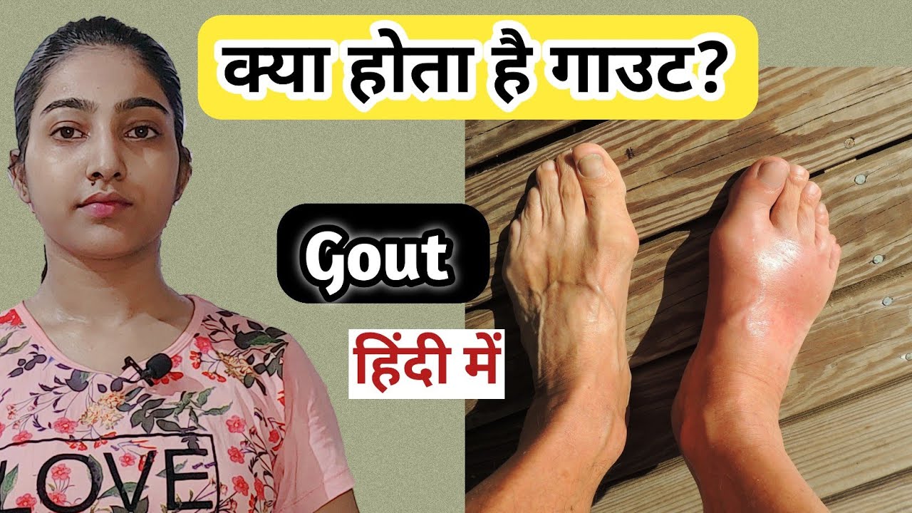 What is gout?|Gout causes, symptoms and treatment