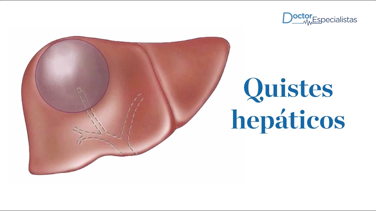 Quiste hepáticos - Doctores Especialistas