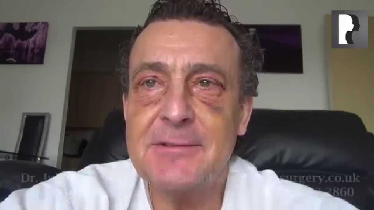 10 Male Blepharoplasty, Eyelid Lift Diary -Day 8 after surgery