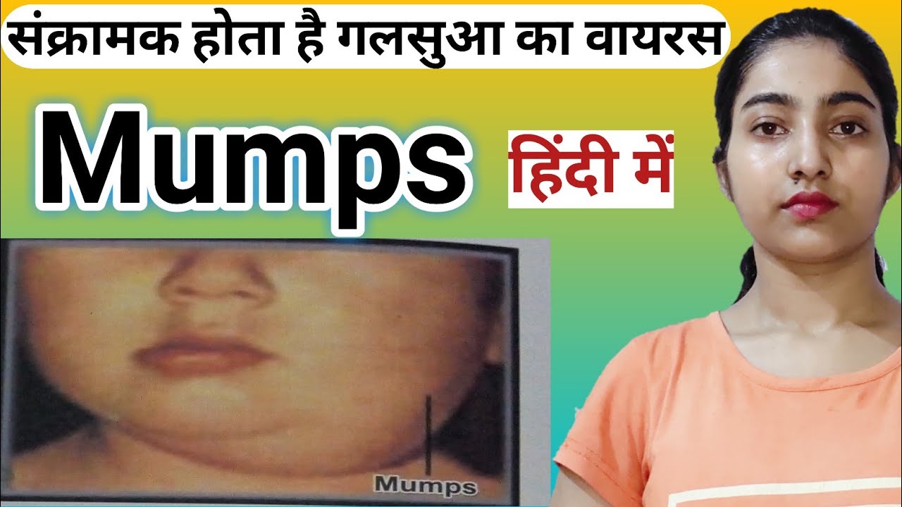 Mumps disease in hindi |Causes and risk factors|Symptoms|Diagnosis|Treatment|Prevention|Msn|