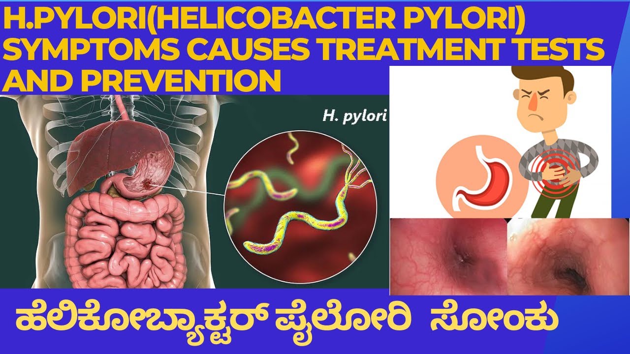 H.Pylori(helicobacterpylori)spread,lab tests symptoms,complication treatment  prevention in kannada.