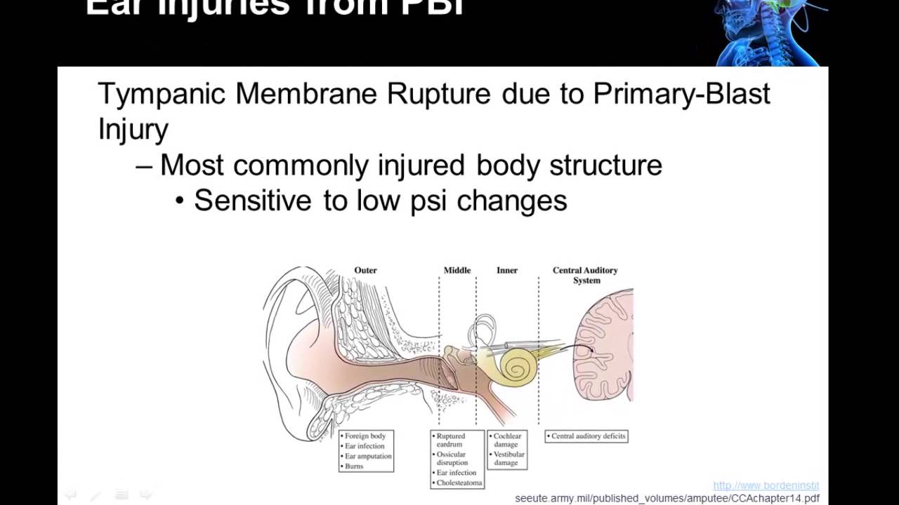 01 08 Traumatic Brain Injury:  Blast Induced Injury