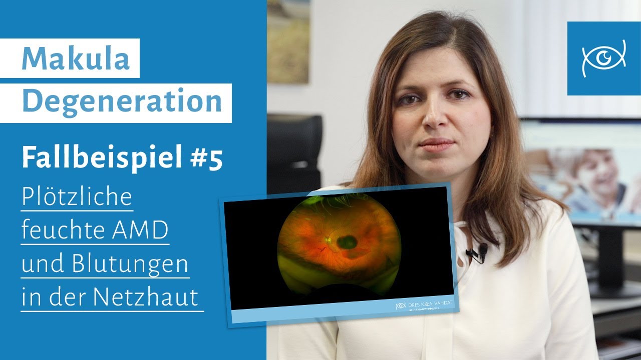 Augenerkrankung Makula Degeneration | Fallbeispiel | Plötzliche feuchte AMD & Blutung in Netzhaut