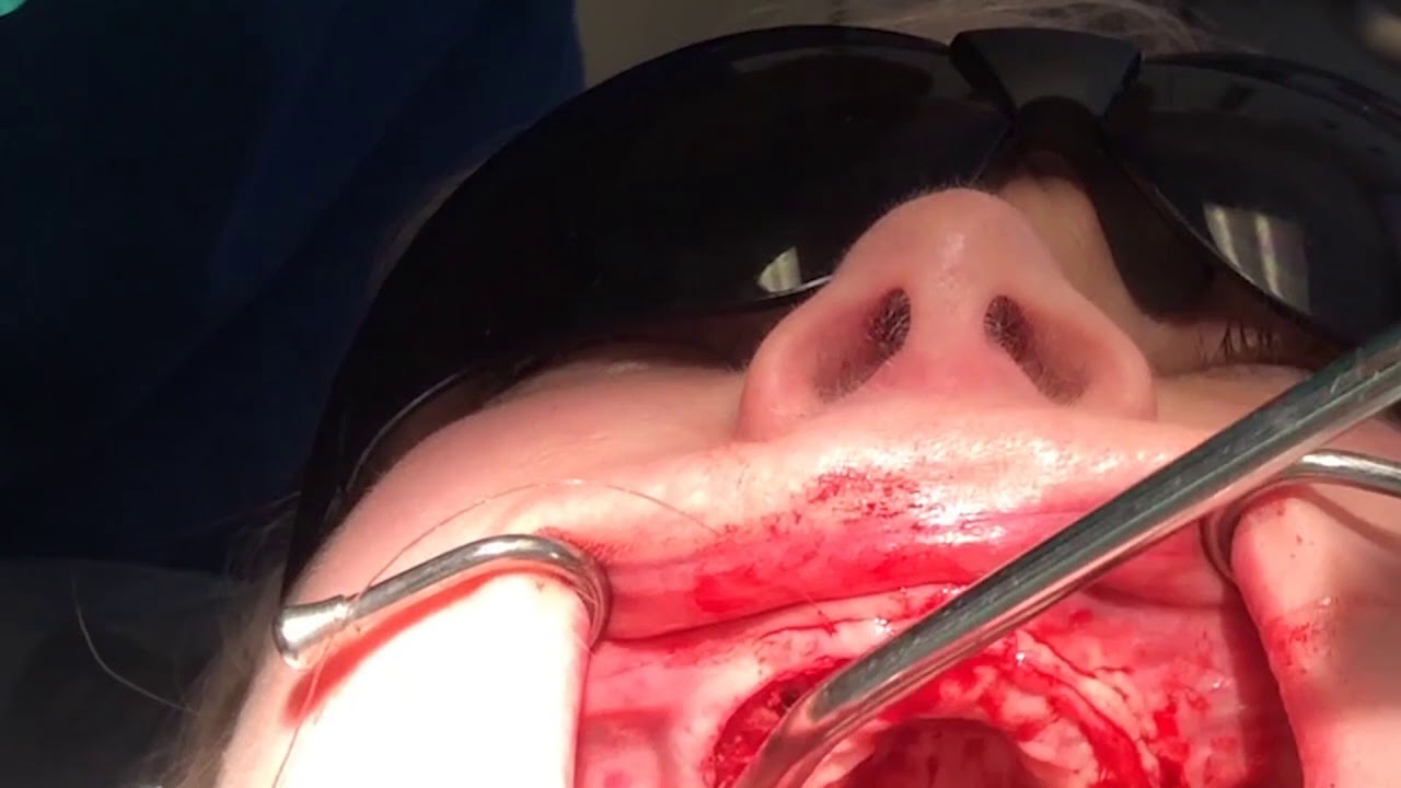 Stratafix Knotless Tissue - Full Arch Wound Closure with Dr. Raman Kohli