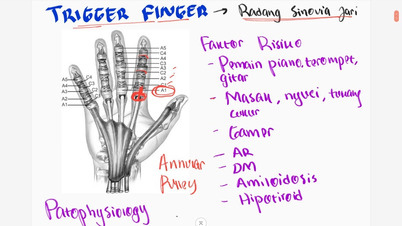 Patofisiologi Trigger Finger : Nyeri di Sendi Jari Karena Inflamasi