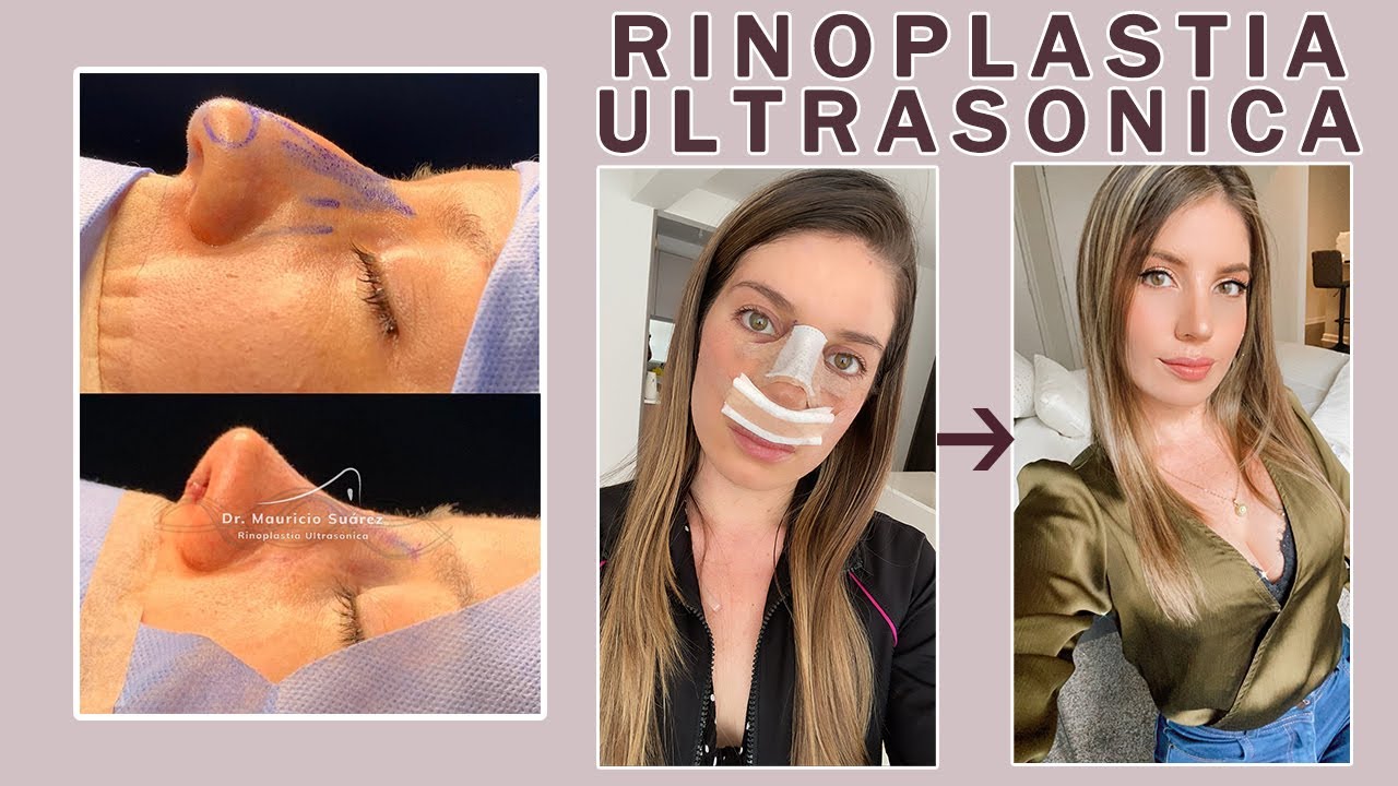 Me opere la nariz! 😱 - Rinoplastia Ultrasonica - MI EXPERIENCIA -
