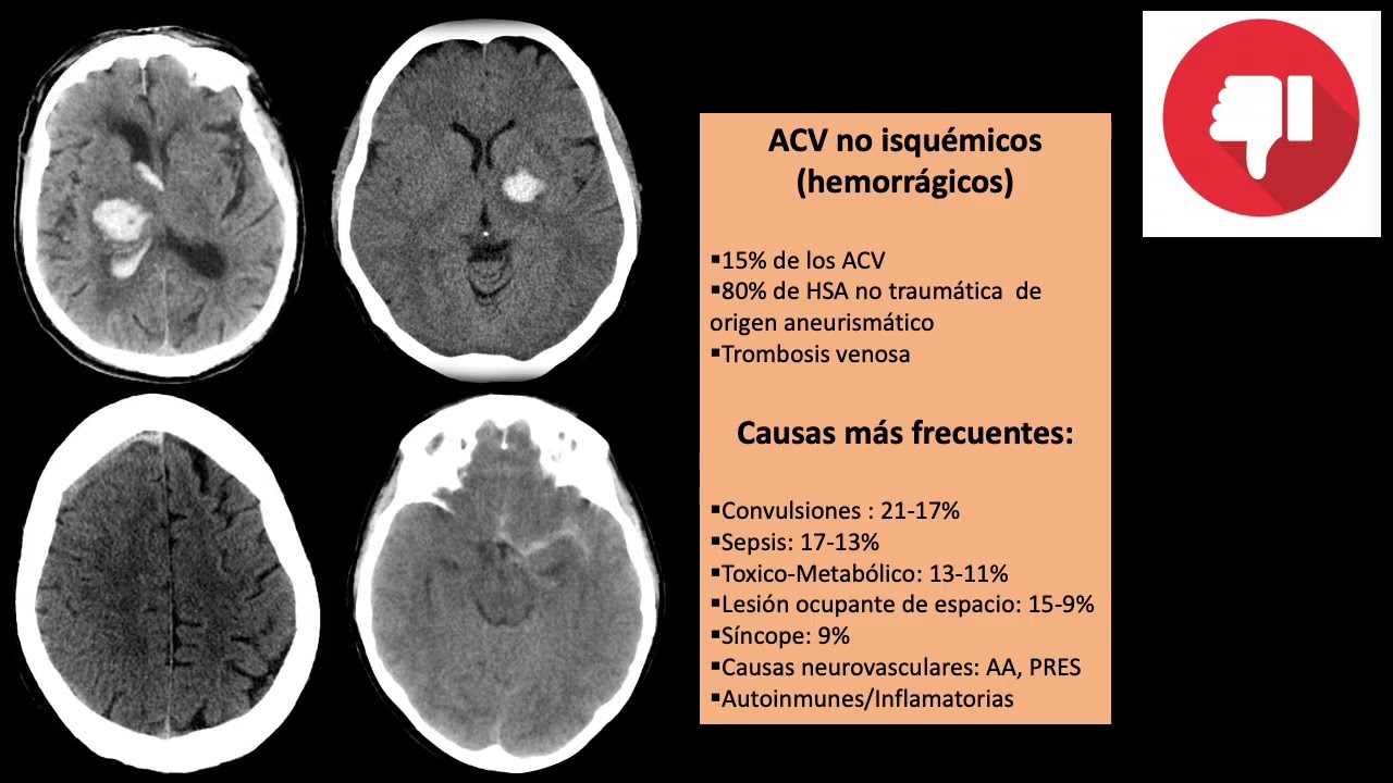 ACV GRABADA