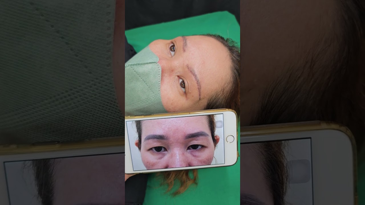 GIẢI QUYẾT ĐÔI MẮT BUỒN - Nâng cung chân mày + chuyển mỡ mắt DR Vĩnh - Thẩm mỹ Chợ rẫy 0905388576