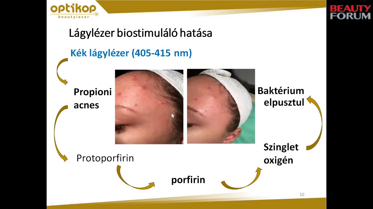 Lágylézer-kezelés a kozmetikában nyáron