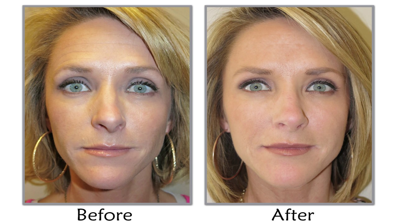 How To Get Natural Looking Botox Results