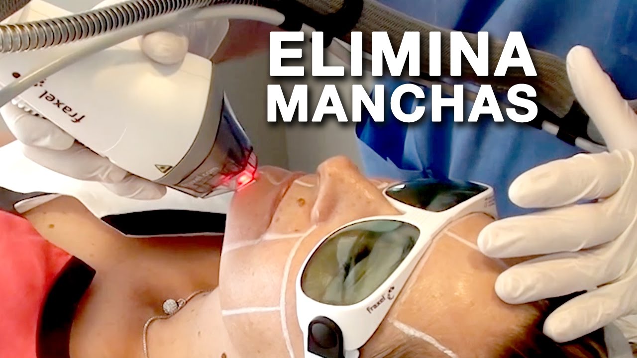Láser Fraxel antes y después | Elimina manchas y Rejuvenece