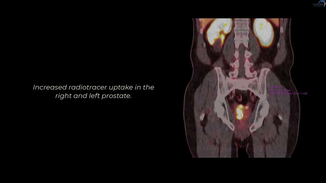 PSMA PET CT and MRI Prostate Cancer