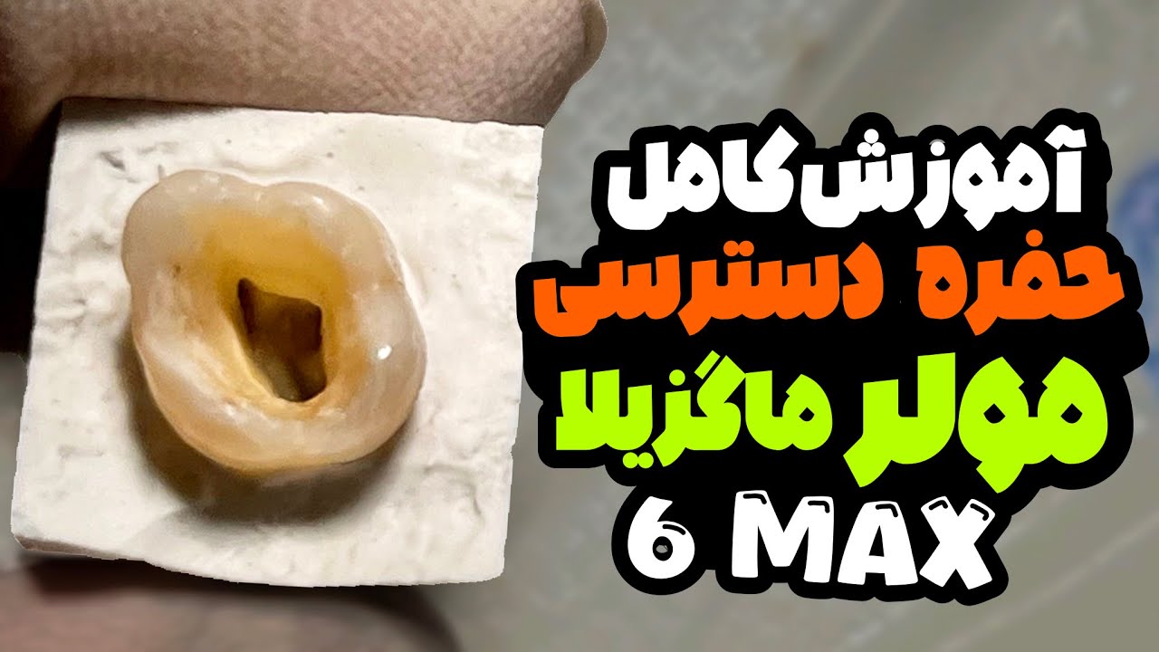 access cavity of upper 6 step by step/تهیه حفره دسترسی مولر بالا