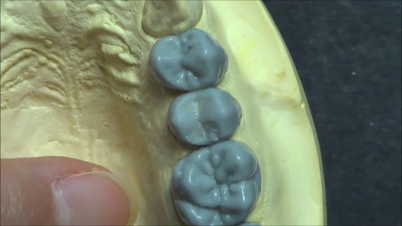Live wax up - Upper 2nd premolar(full)