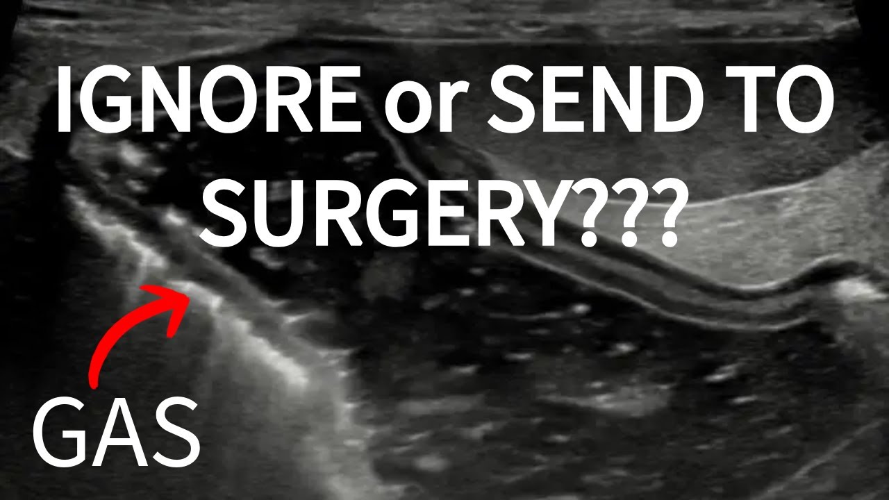 Gas in the gastric wall: Ignore or send to surgery?