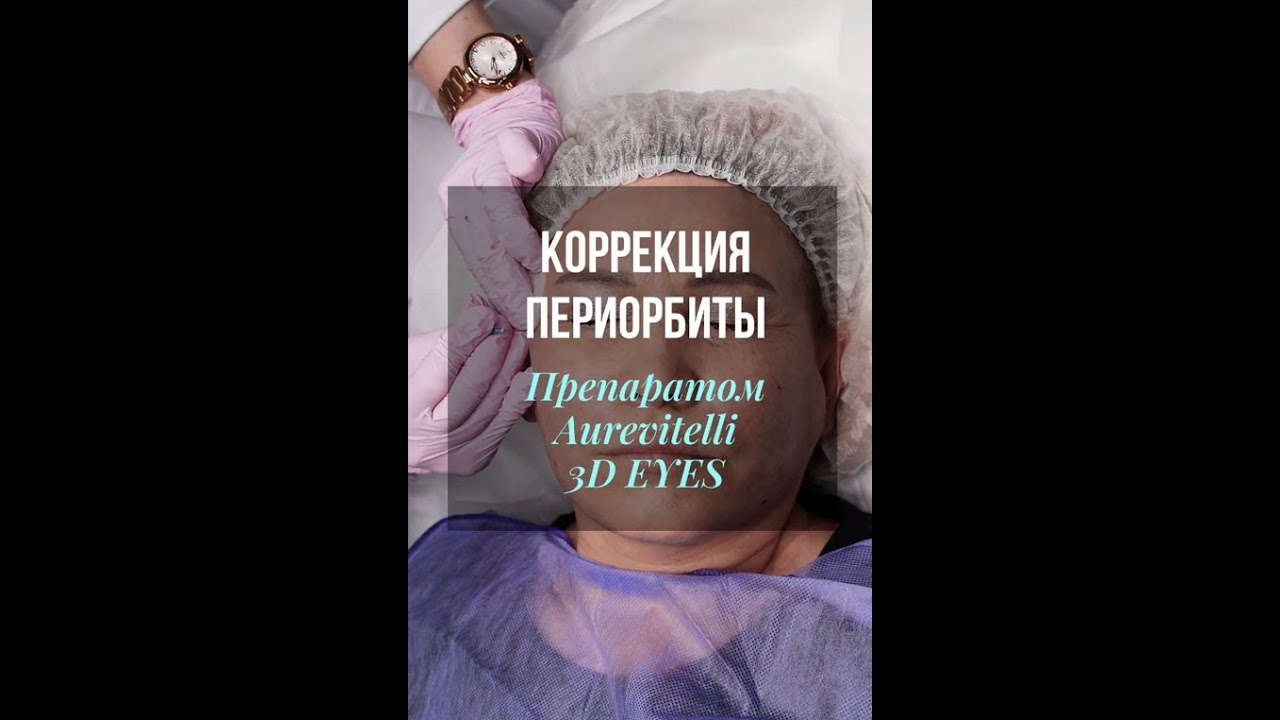 Коррекция периорбитальной области мезокомплексом Aurevitelli 3D EYES