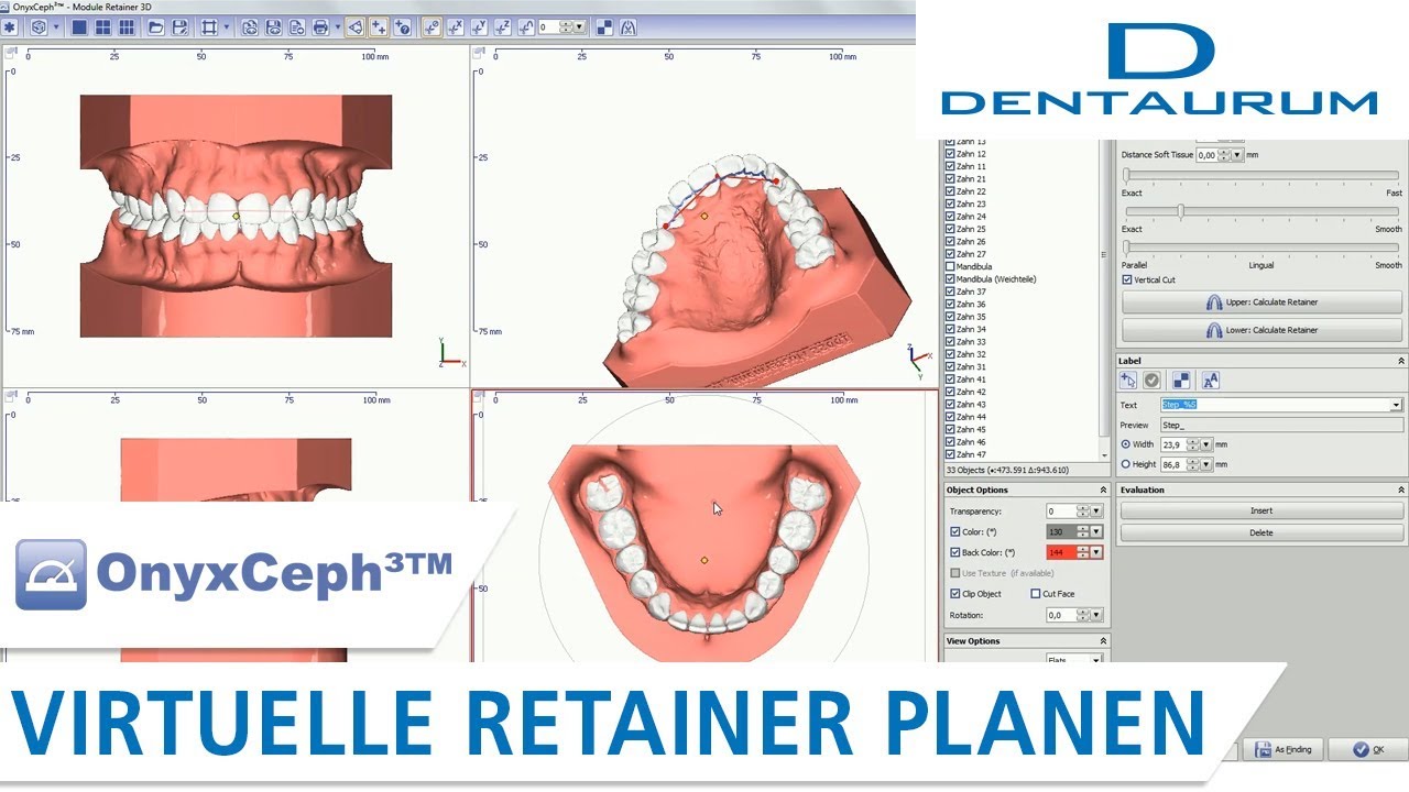 Modul Retainer 3D: Virtuelle Retainer Planung in OnyxCeph3TM