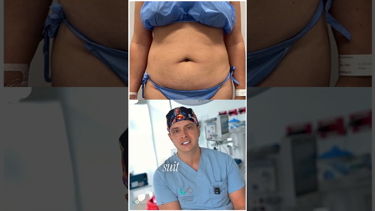 Este es un caso muy interesante de Abdominoplastia HD
