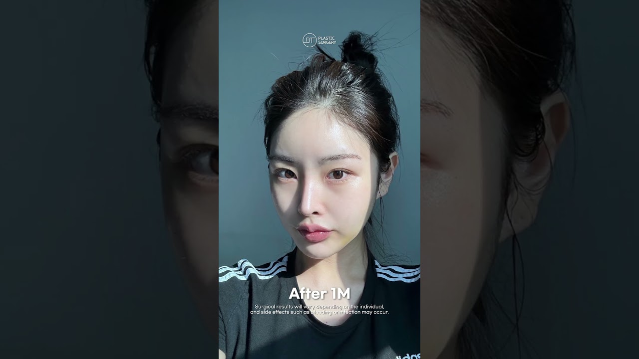 Facial Contouring Surgery Recovery Before & After