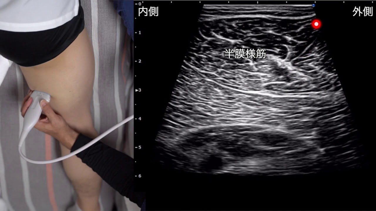 ハムストリングス起始部