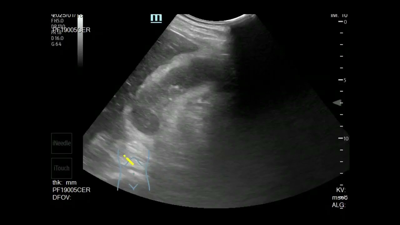 20251003 雙和急診超音波教學-hepatobiliary system (part 3)