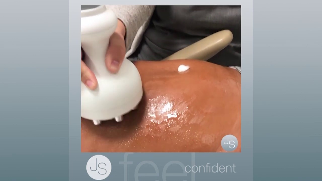 What does Venus Legacy Feel Like | Patient Experience | Dr Jaime Schwartz FACS