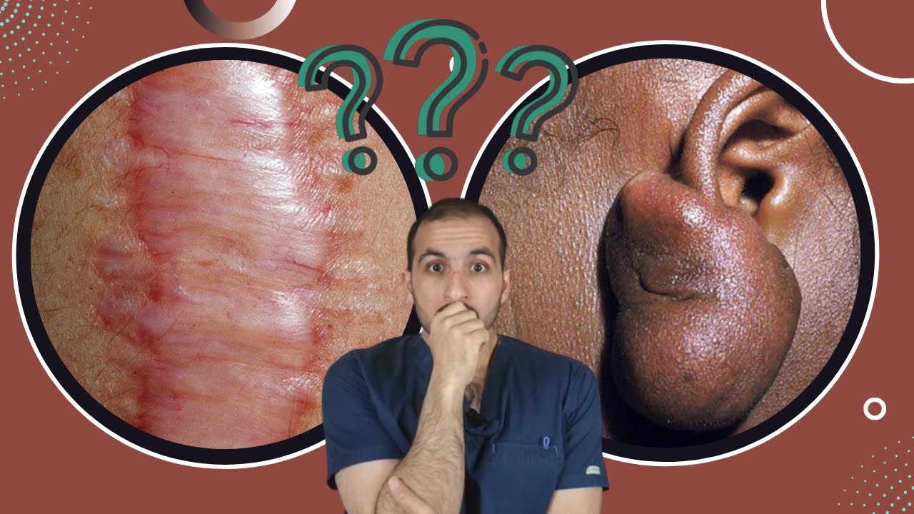 ويش هذا ؟؟ (الجدرة و الندبة المتضخمة)