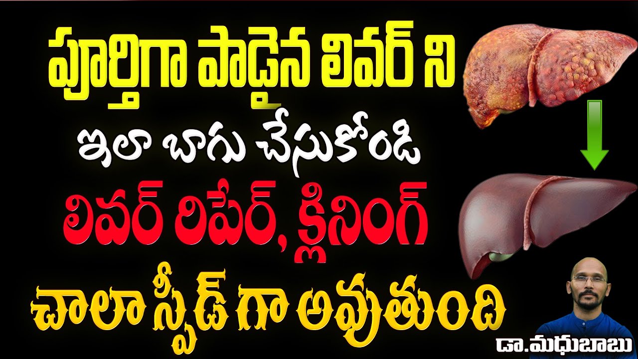 పూర్తిగా పాడైన లివర్ ని ఇలా బాగు చేసుకోండి  | | Dr.Madhu Babu Health Trends
