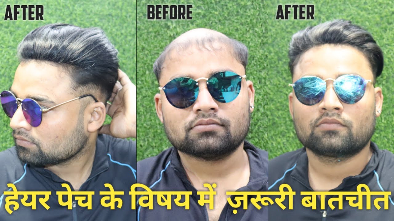 HAIR PATCH DISCUSSIONS Con No 9711944387 Prince king hair