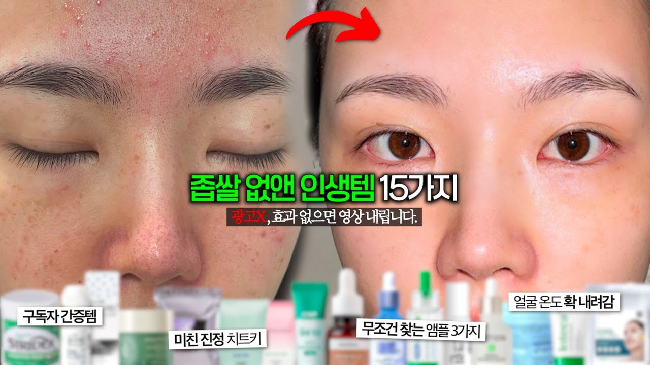 좁쌀 없앤 인생템 15가지 (광고X / 진짜 효과 본 것만)