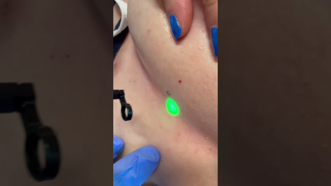 How to get rid of red spots from body in less than a minute.