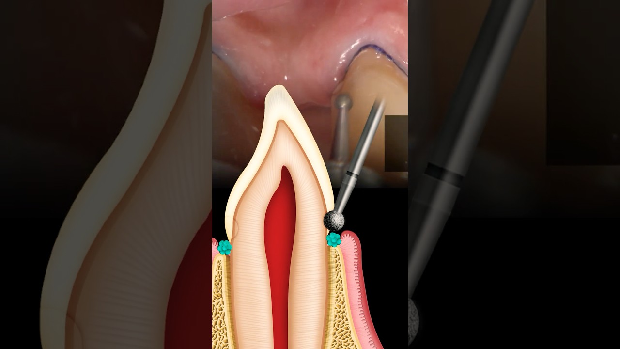 Preparing ANTERIOR Teeth for Zirconia Crowns #dentalshorts