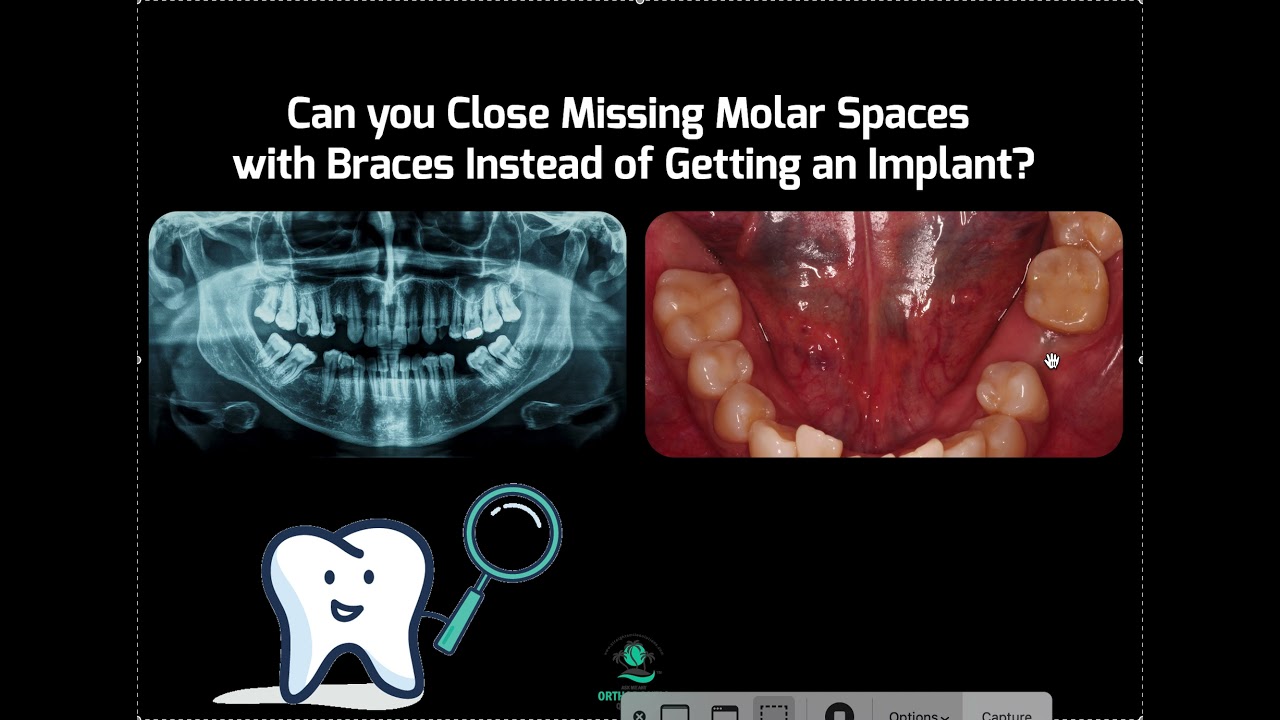 Is it Possible to Close Missing Molar Spaces with Invisalign or Braces?