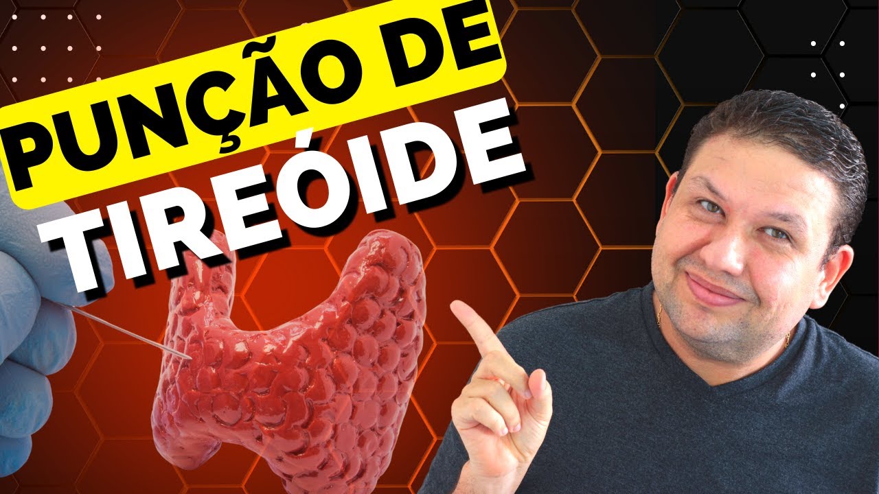 PUNÇÃO DE NÓDULO DE TIREÓIDE, COMO É FEITO O EXAME ! PAAF da tireóide, Punção de nódulos da tireóide