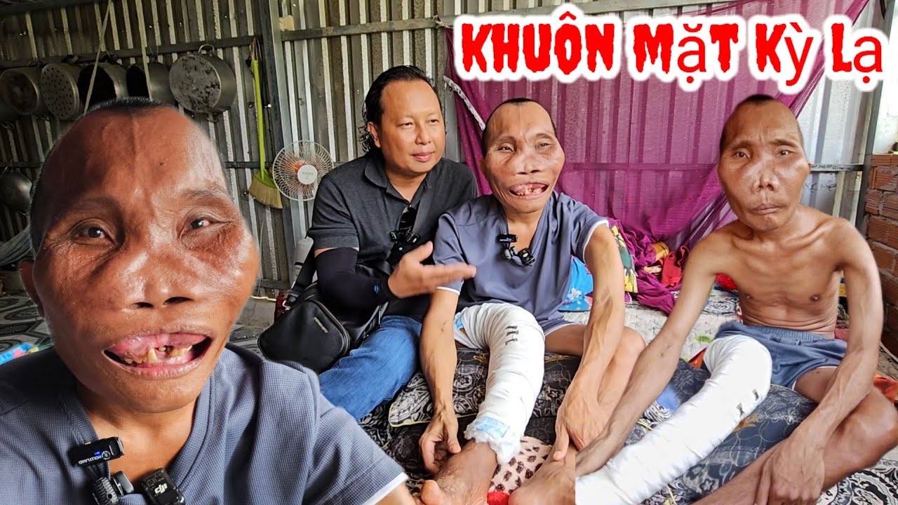 Người đàn Ông có khuôn mặt Kỳ Lạ biệt danh ( Bát Giới ) bán vé số mưu sinh 