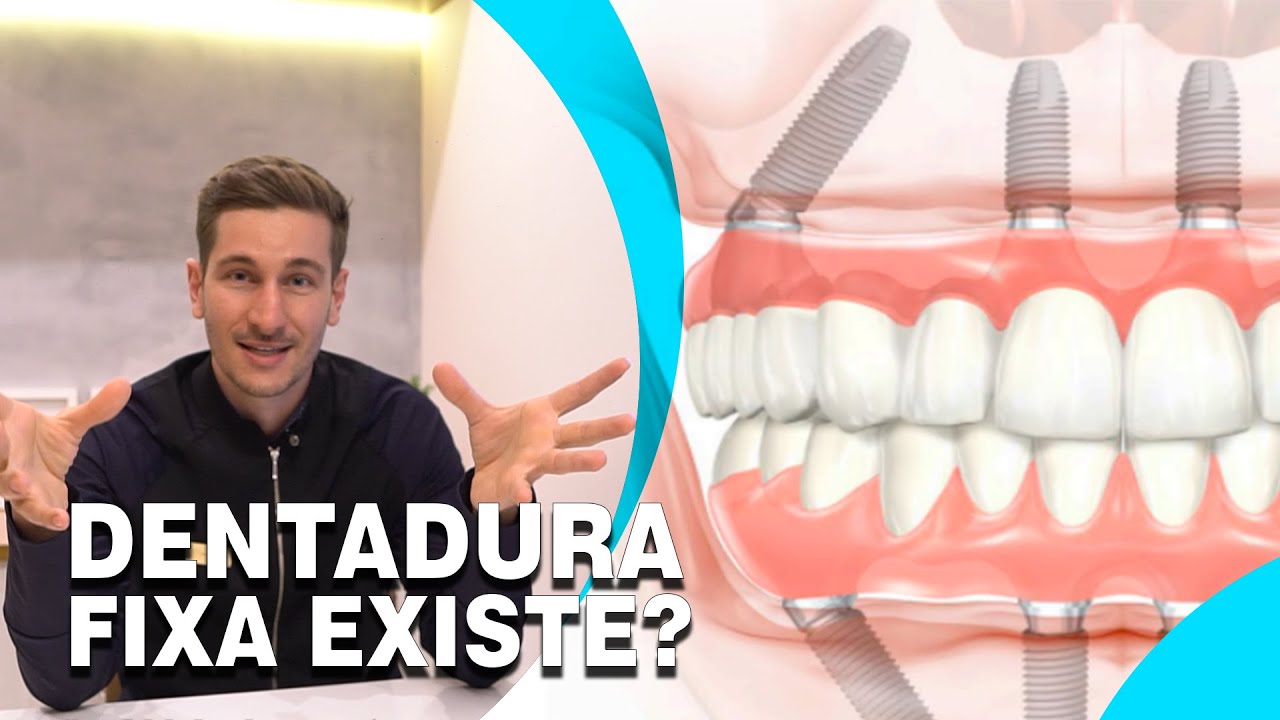 É Possível Parafusar a Dentadura? Oque é Prótese Protocolo? - Heal Odontologia