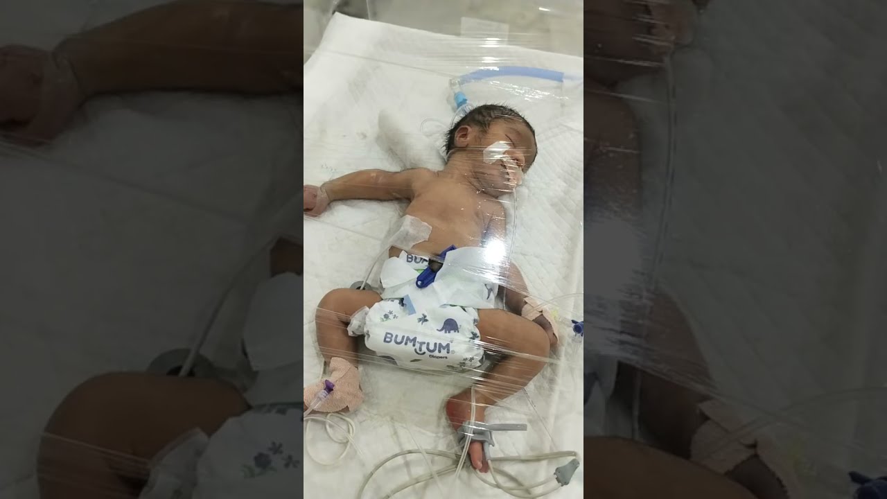 NICU! BABY ON VENTILATOR NIV PRESSURE CONTROL SUPPORT 🫁🩺👨‍⚕️