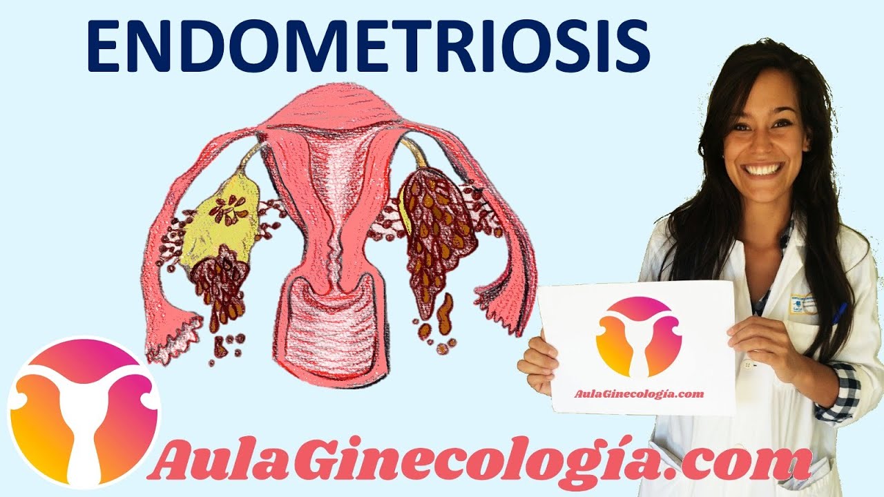 ENDOMETRIOSIS I: patogenia, síntomas y diagnóstico   - Ginecología y Obstetricia