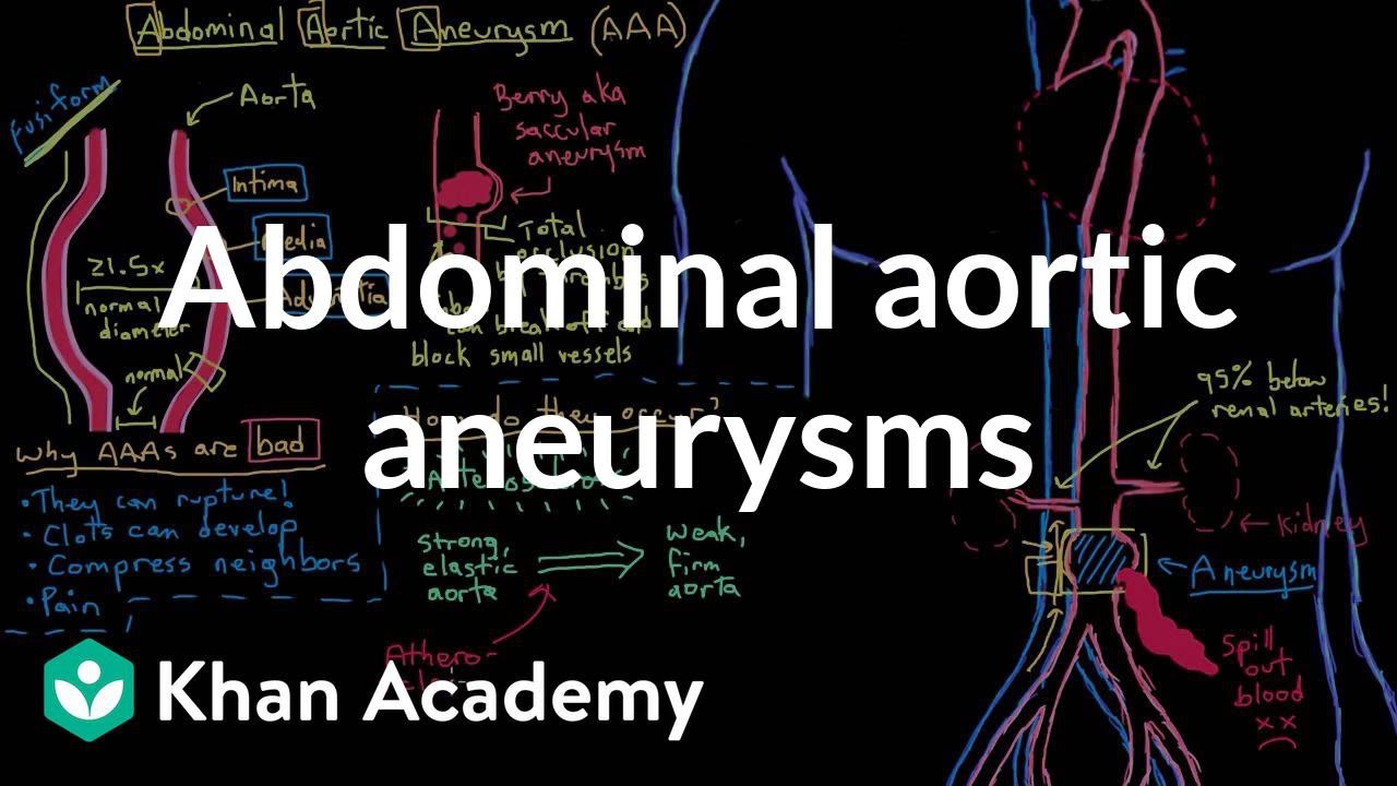 Abdominal aortic aneurysms | Circulatory System and Disease | NCLEX-RN | Khan Academy
