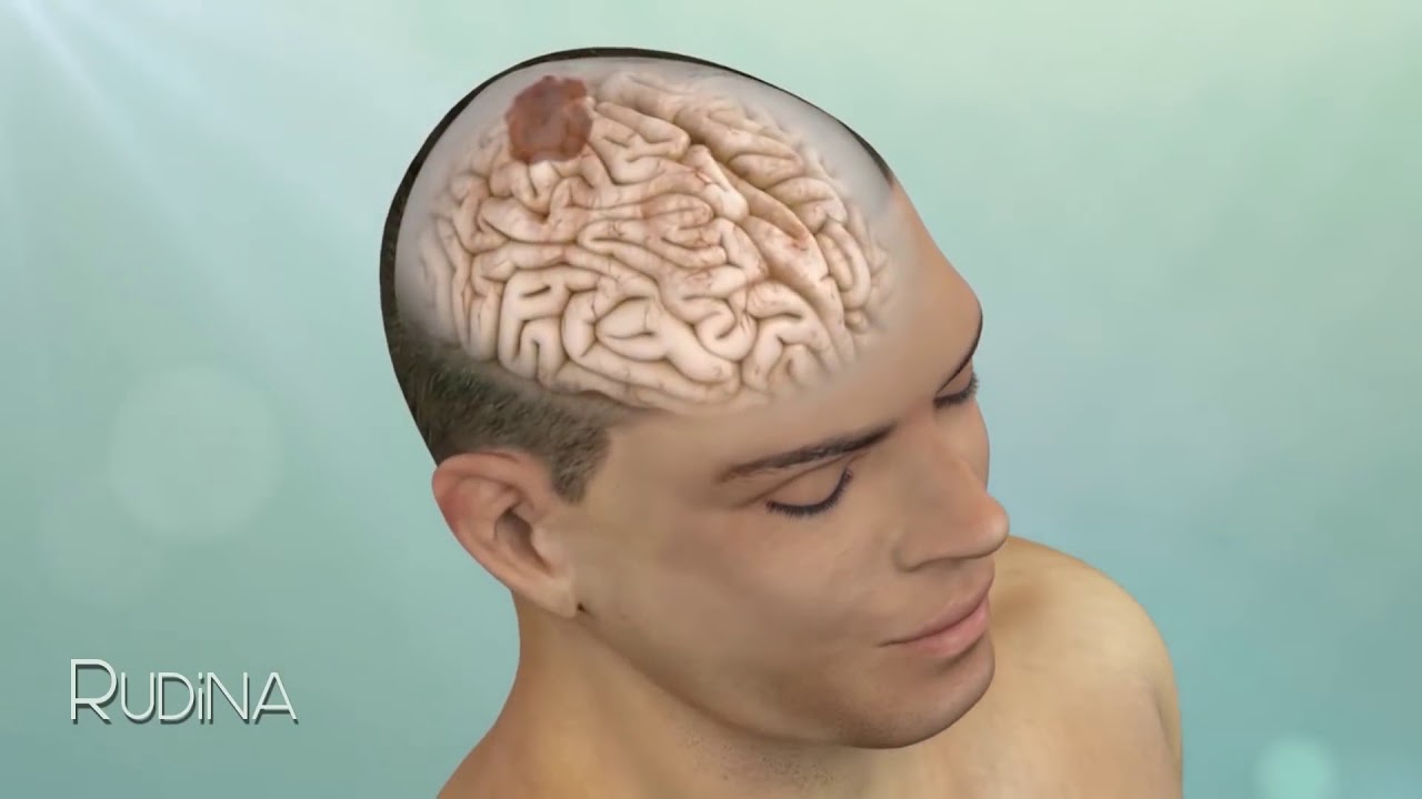 Metodat kirurgjikale të trajtimit të tumoreve të mëlcisë dhe të tumoreve të kokës në Acibadem