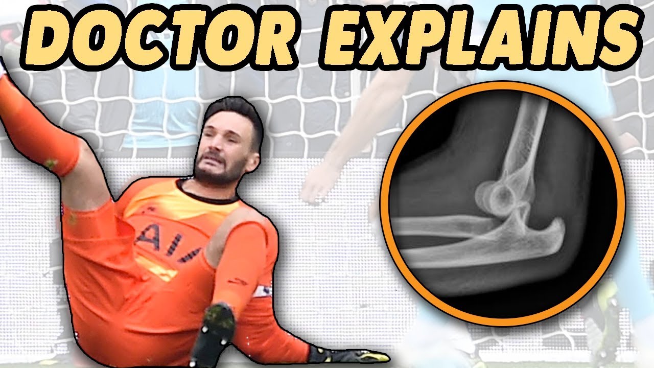 Doctor's Guide to Hugo Lloris Elbow Dislocation