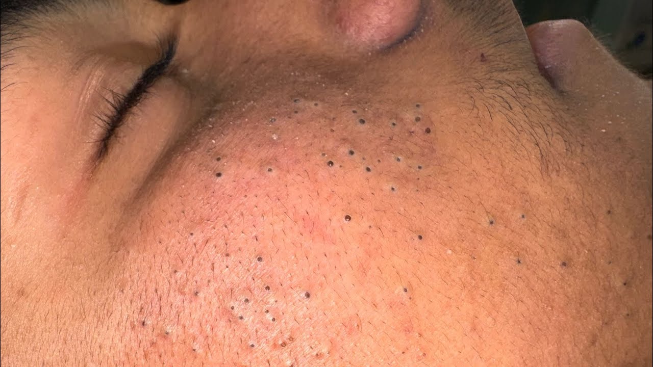 Идеальный уход за лицом | Методы глубокого очищения при акне и черных точках