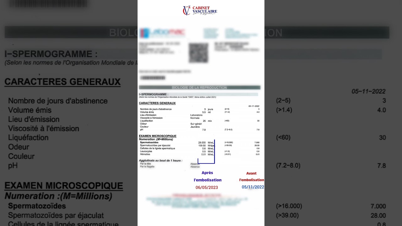 Avant et apr&egrave;s le traitement des varicoc&egrave;les par embolisation