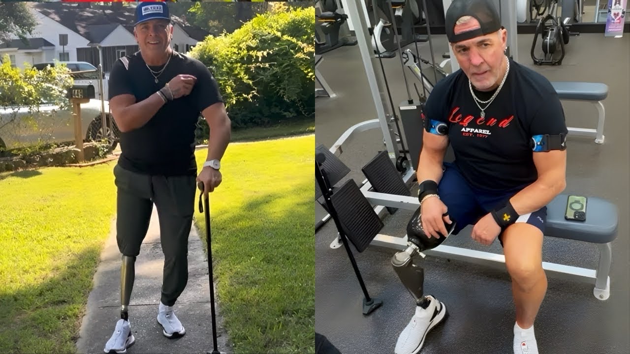 My First Steps On My New Prosthetic Leg