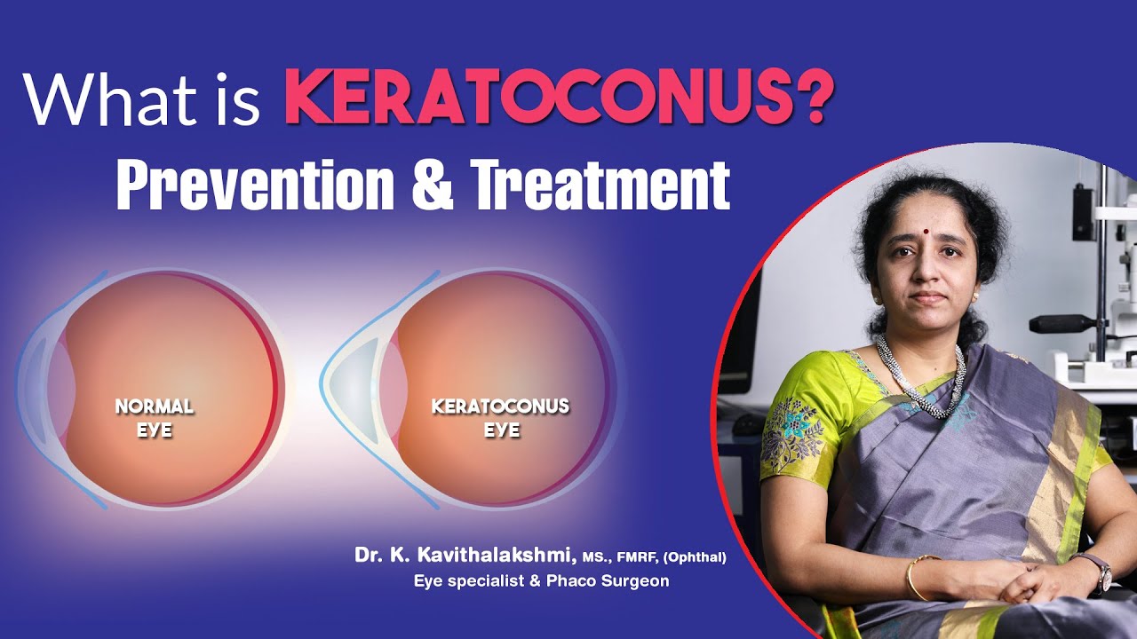 What is Keratoconus? | Prevention & Treatment for Keratoconus | Dr. Kavithalakshmi