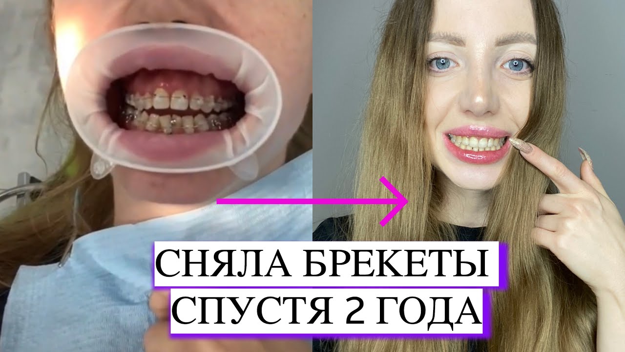 БРЕКЕТЫ ДО И ПОСЛЕ СПУСТЯ 2 ГОДА. СНЯТИЕ, ЦЕНА ИДЕАЛЬНЫХ ЗУБОВ ЗА ВСЕ ВРЕМЯ