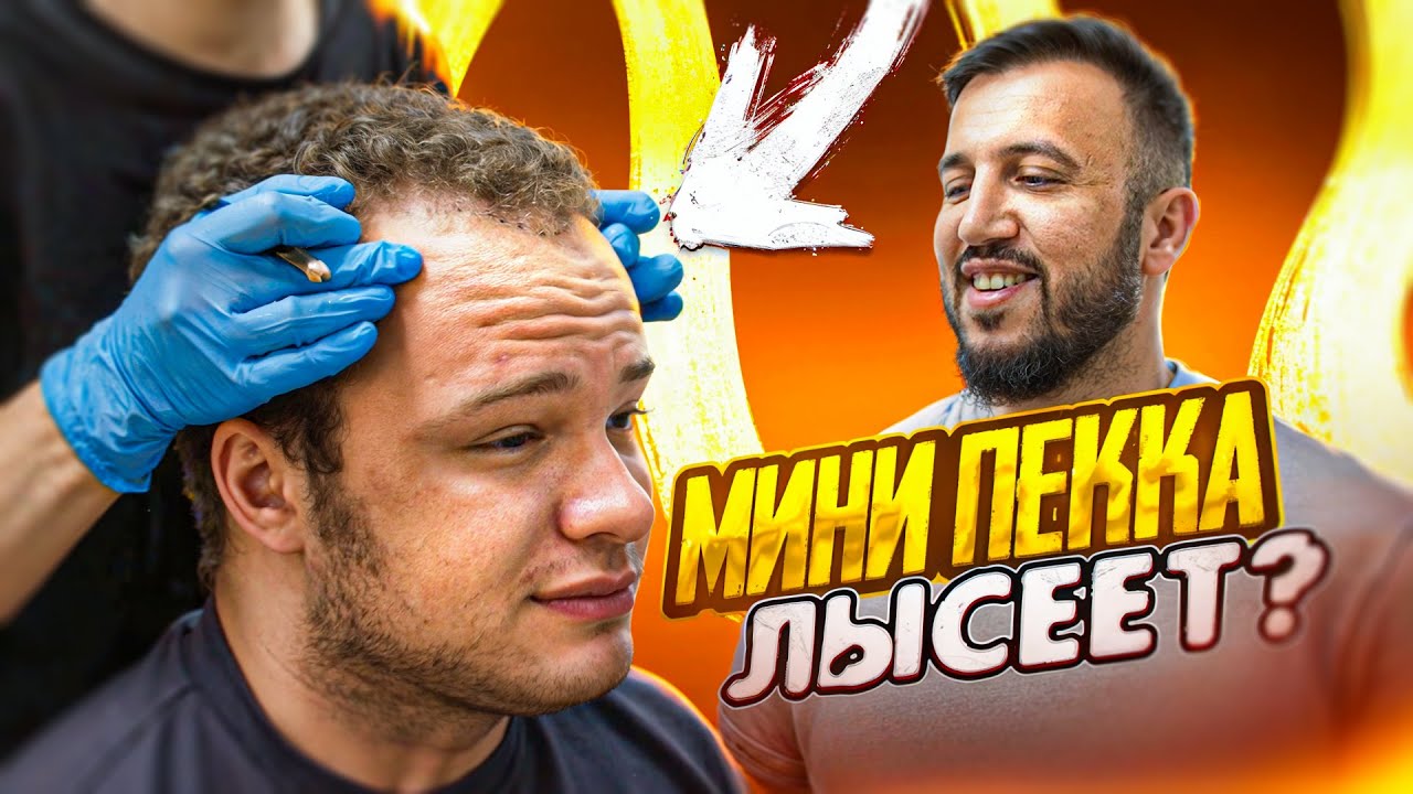 ЗАЧЕМ МИНИ ПЕККЕ ПЕРЕСАДКА ВОЛОС?