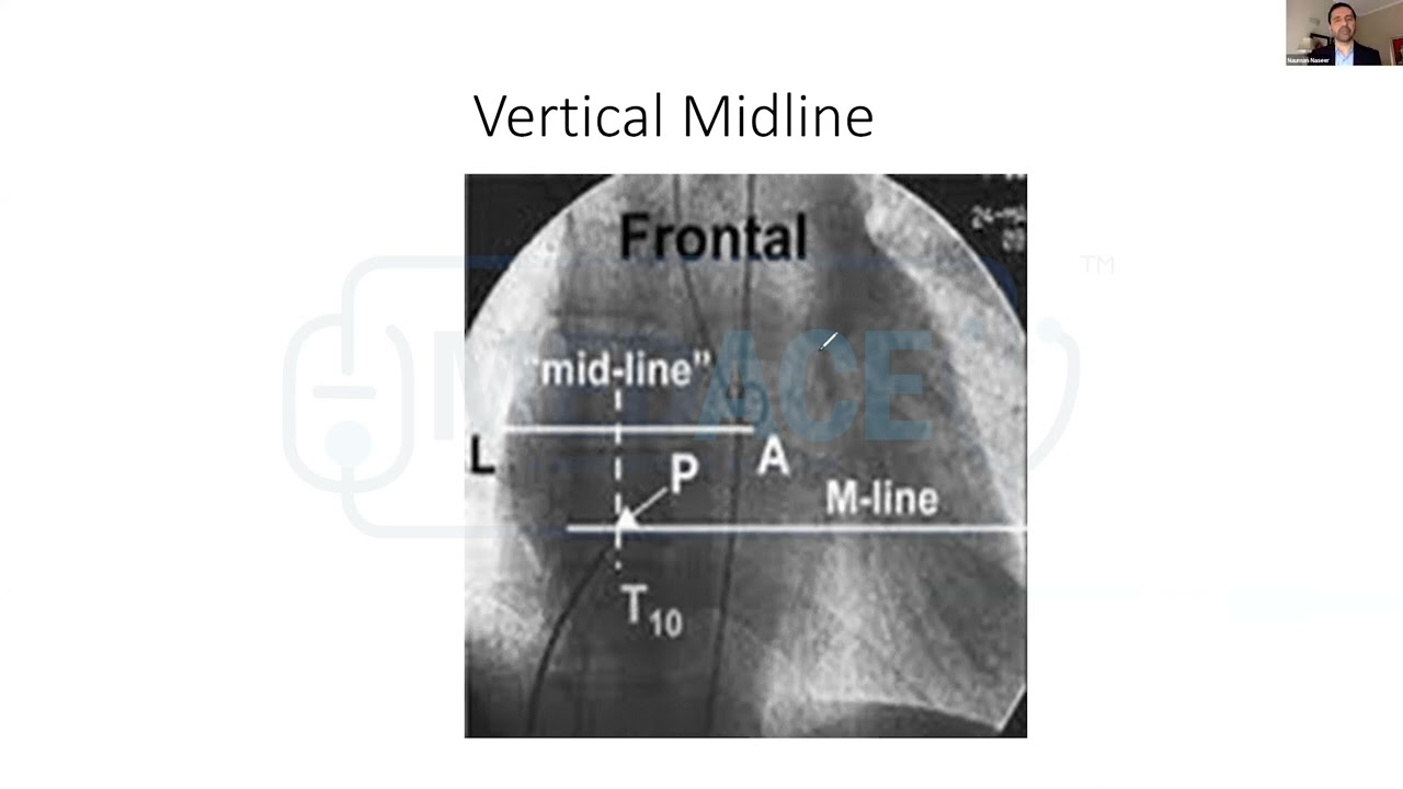 Step of PTMC-Transseptal Puncture & PMBV with Pakistan society of interventional cardiology (PSIC)